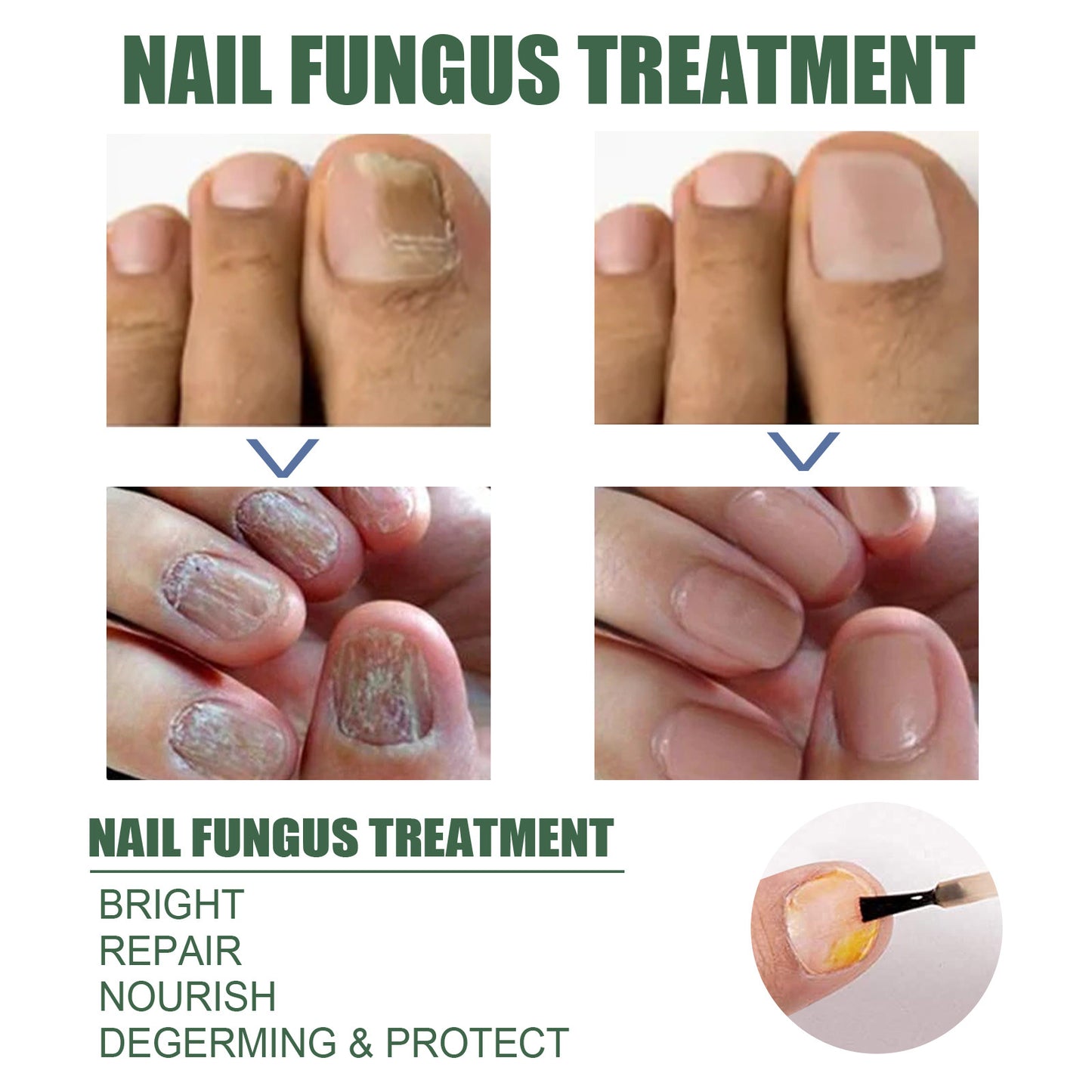 EELHOE Nail Treatment 30ml Nails With Thick Nails And Soft Nails That Gently Cleanse And Moisturize The Nails